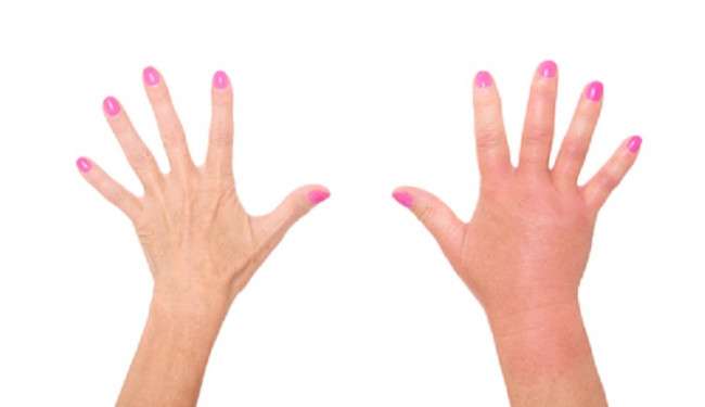 Ödemden Kurtulmanın Yolları