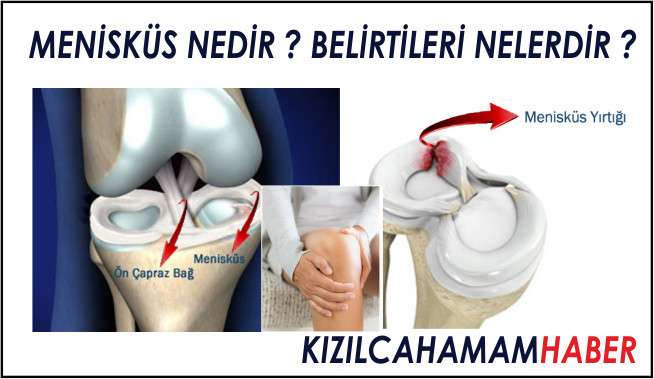 Menüsküs Nedir ? Belirtileri Nelerdir ?